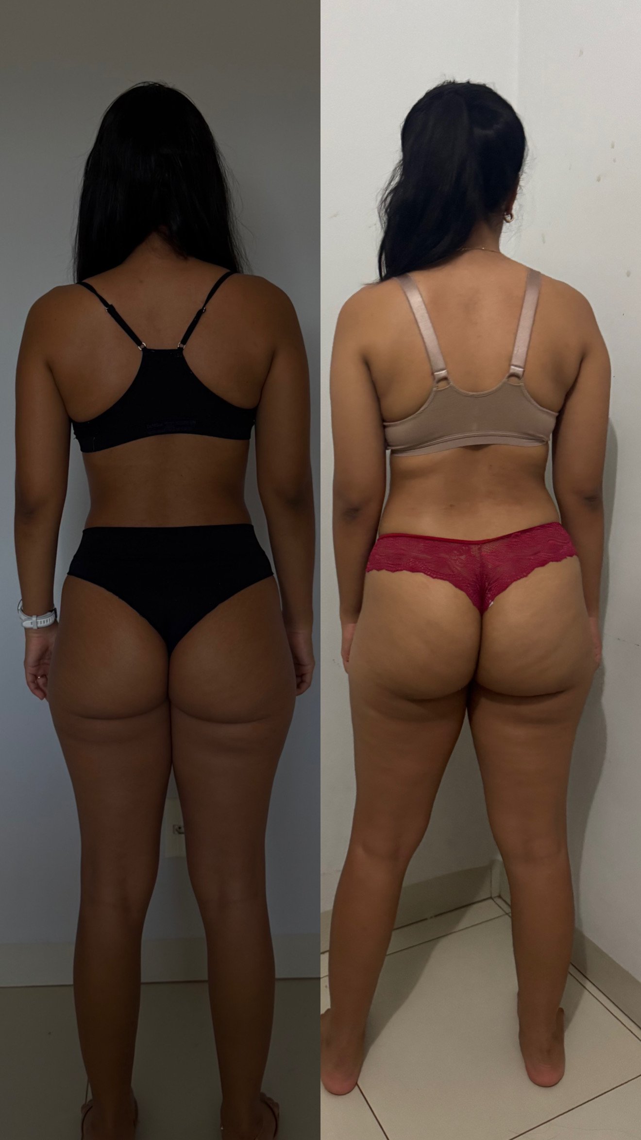 Antes e depois de paciente acompanhado pelo Dr. Lucas Arantes — frente