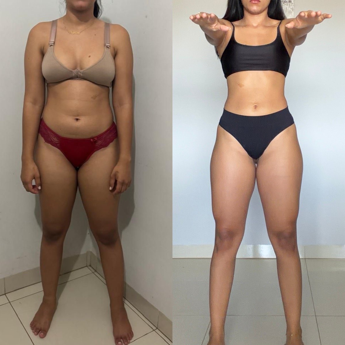 Antes e depois de paciente acompanhado pelo Dr. Lucas Arantes — costas